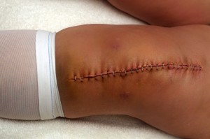 Typical healthy healing scar